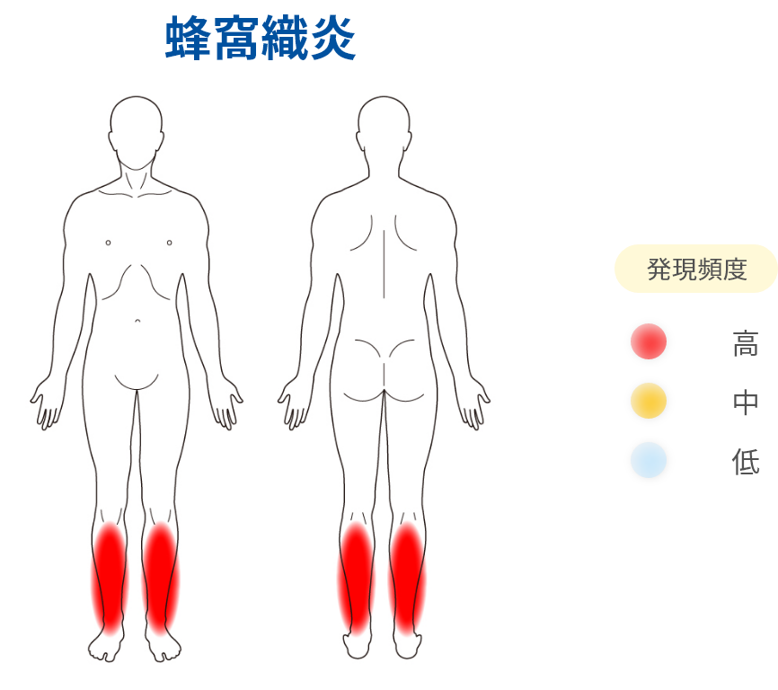 蜂窩織炎